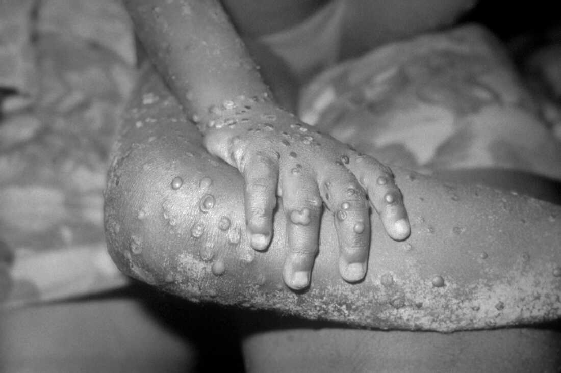 What are the Symptoms of Monkeypox? You Might be Surprised