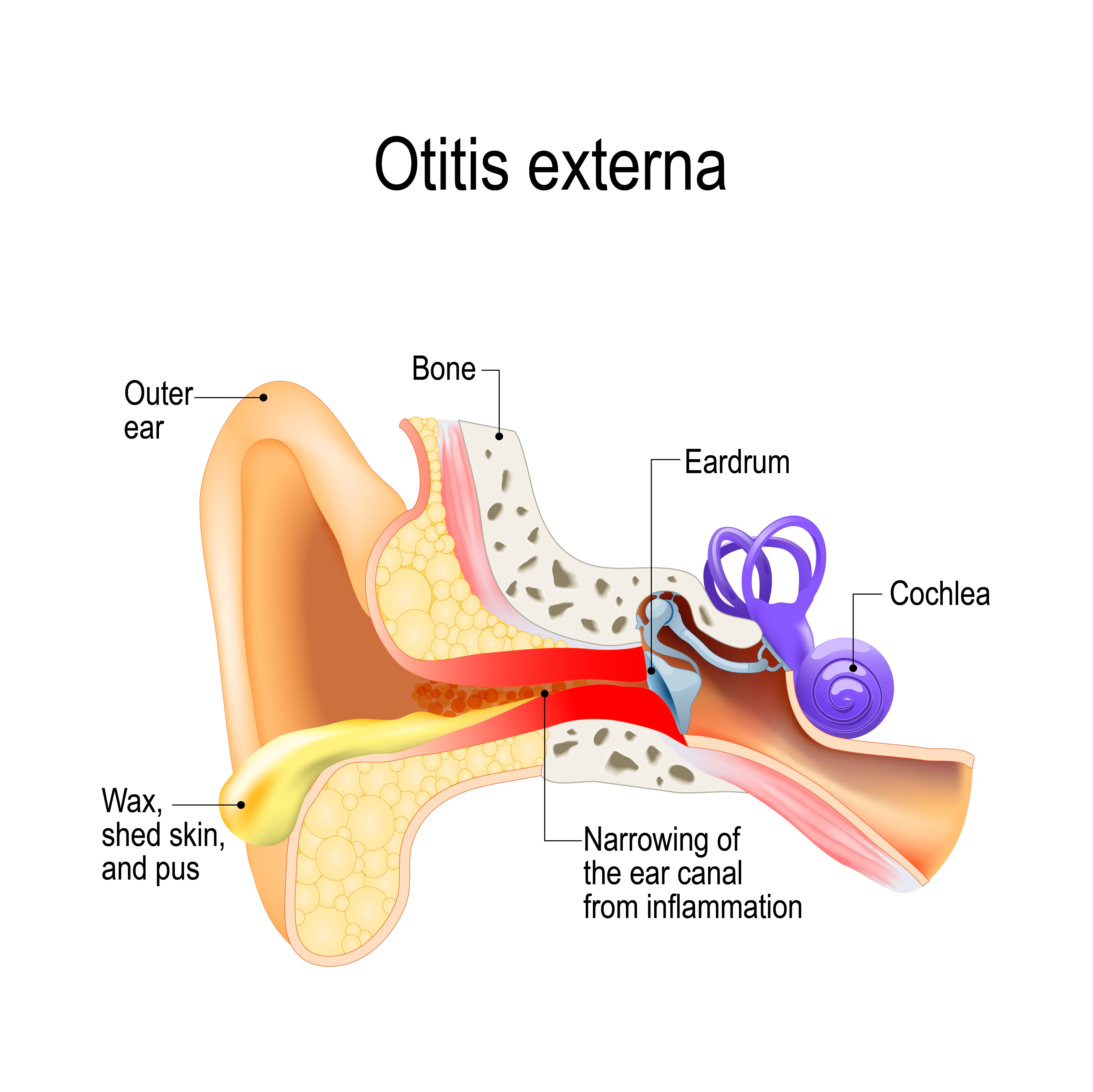 An illustration showing inflammation and narrowing of the ear canal
