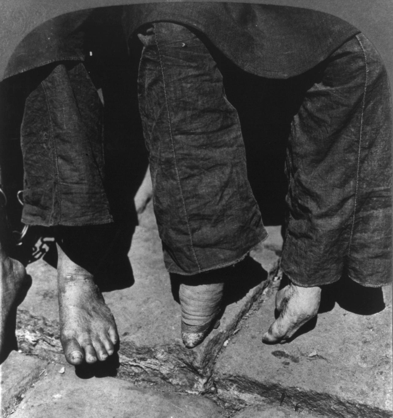 Black and white photograph comparing bound and unbound feet.