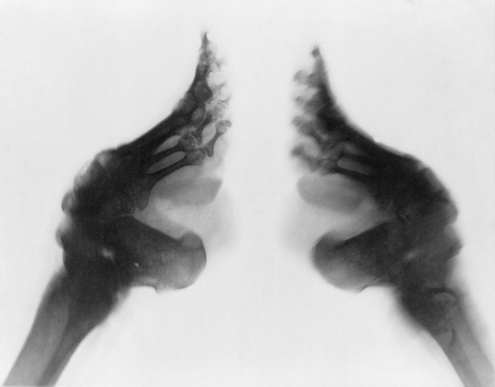 X-ray of a woman's bound feet, China. Ca. 1890-1923.