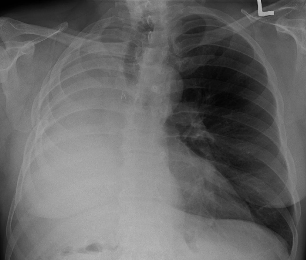 x ray of pneumonectomy patient