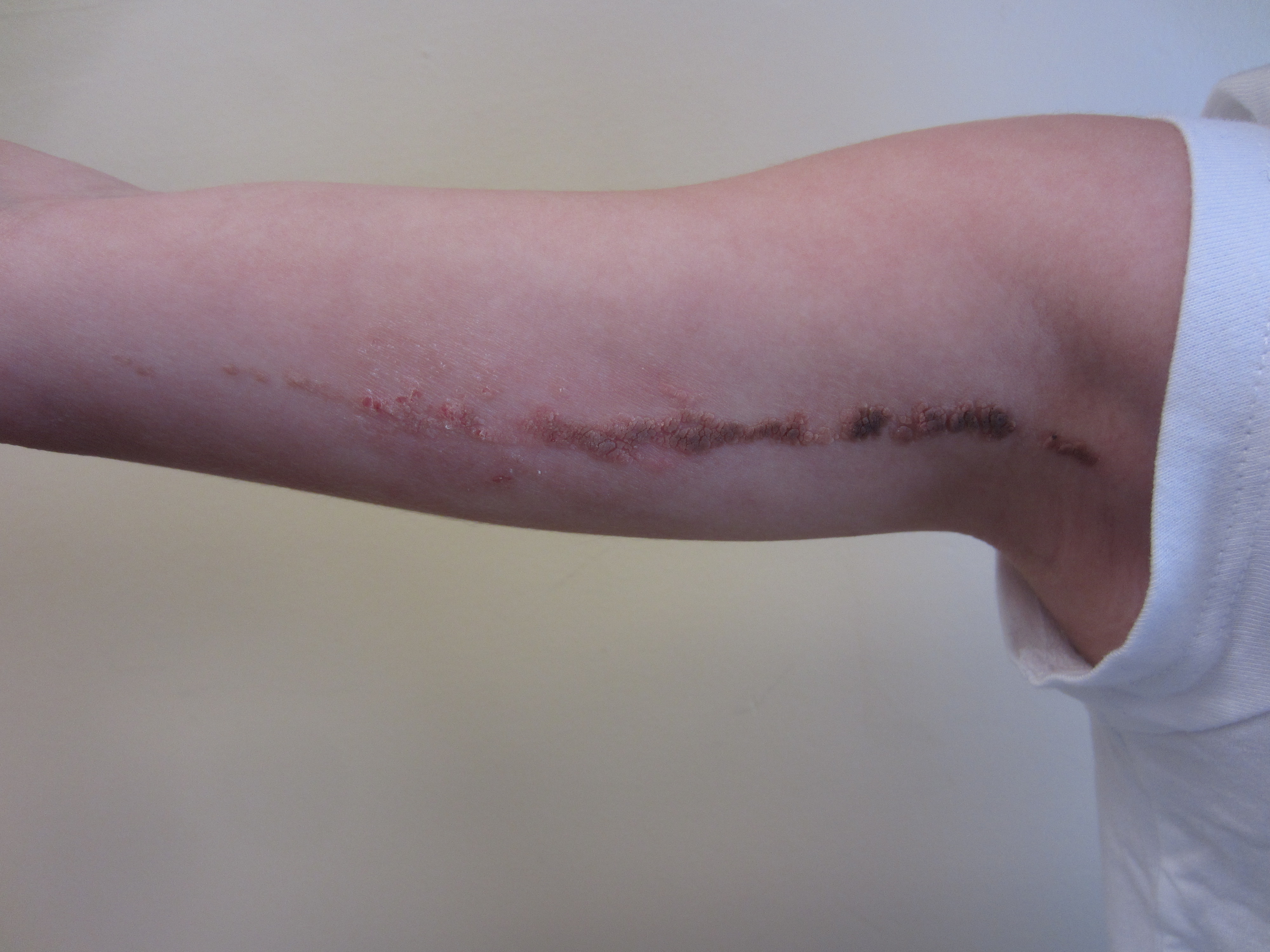 image of inflammatory verrucous linear epidermal nevus on an upper arm