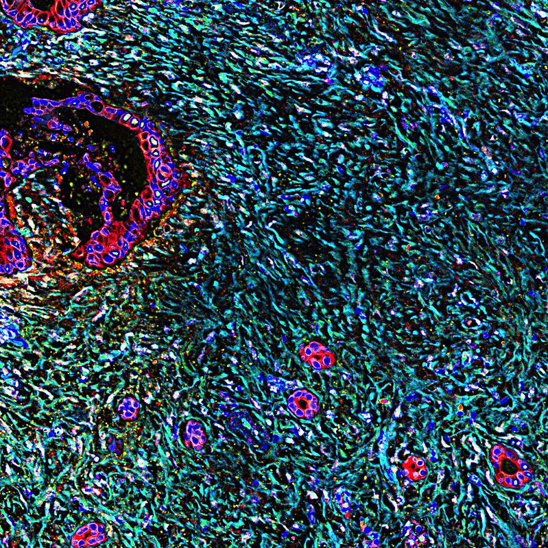 microscopy showing stained pancreatic cells and surrounding desmoplasia