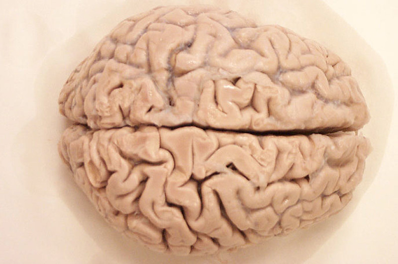 top-down view of formalin-fixed human brain