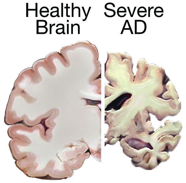 brain from a healthy person vs someone with advanced Alzheimer's showing tissue atrophy