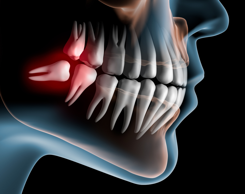 A diagram of a Impacted wisdom teeth