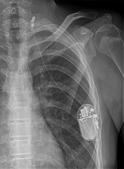 X-ray image showing implanted vagus nerve stimulator