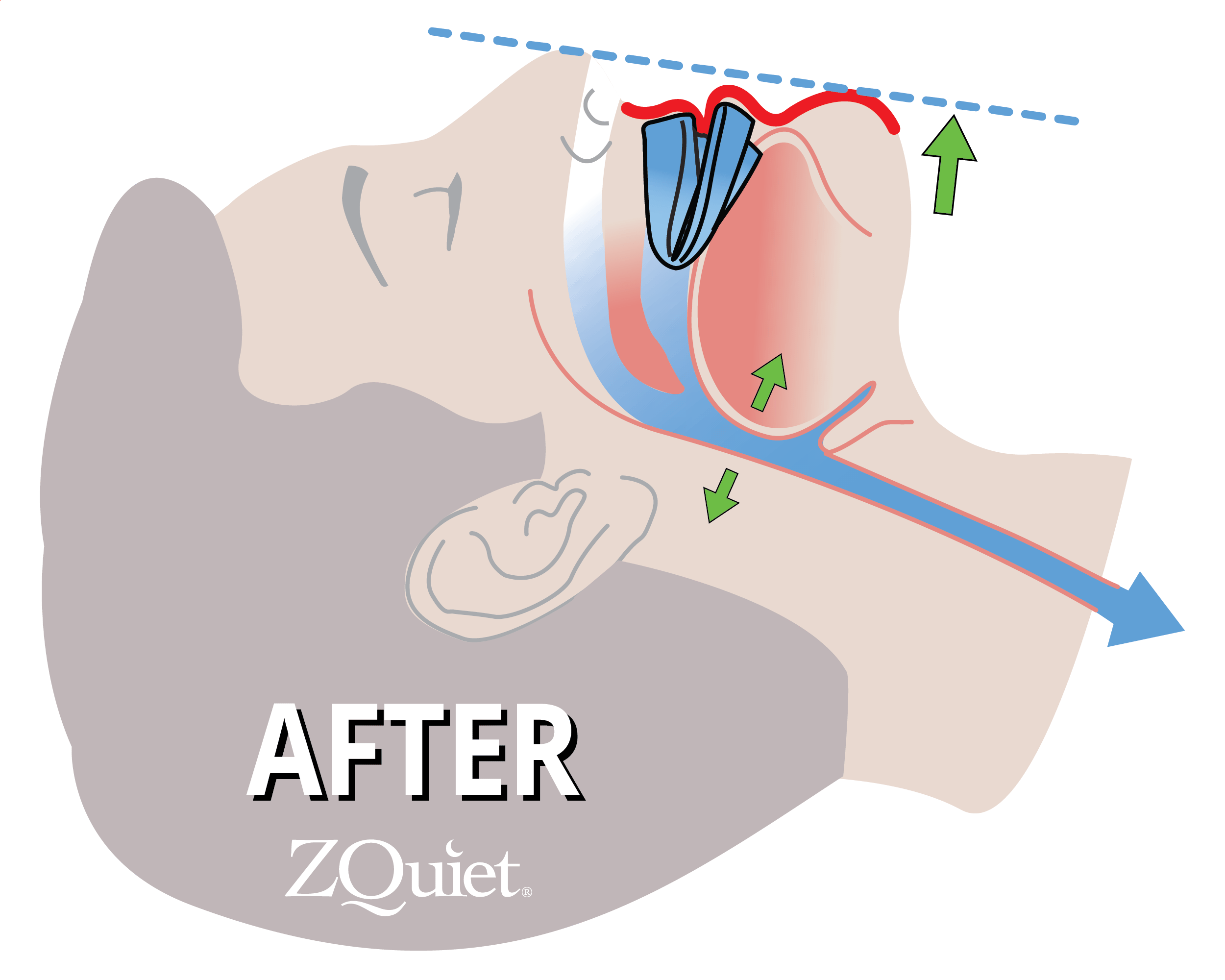 Graphical head image of a man on his side and the airway is still open due to a mouthguard