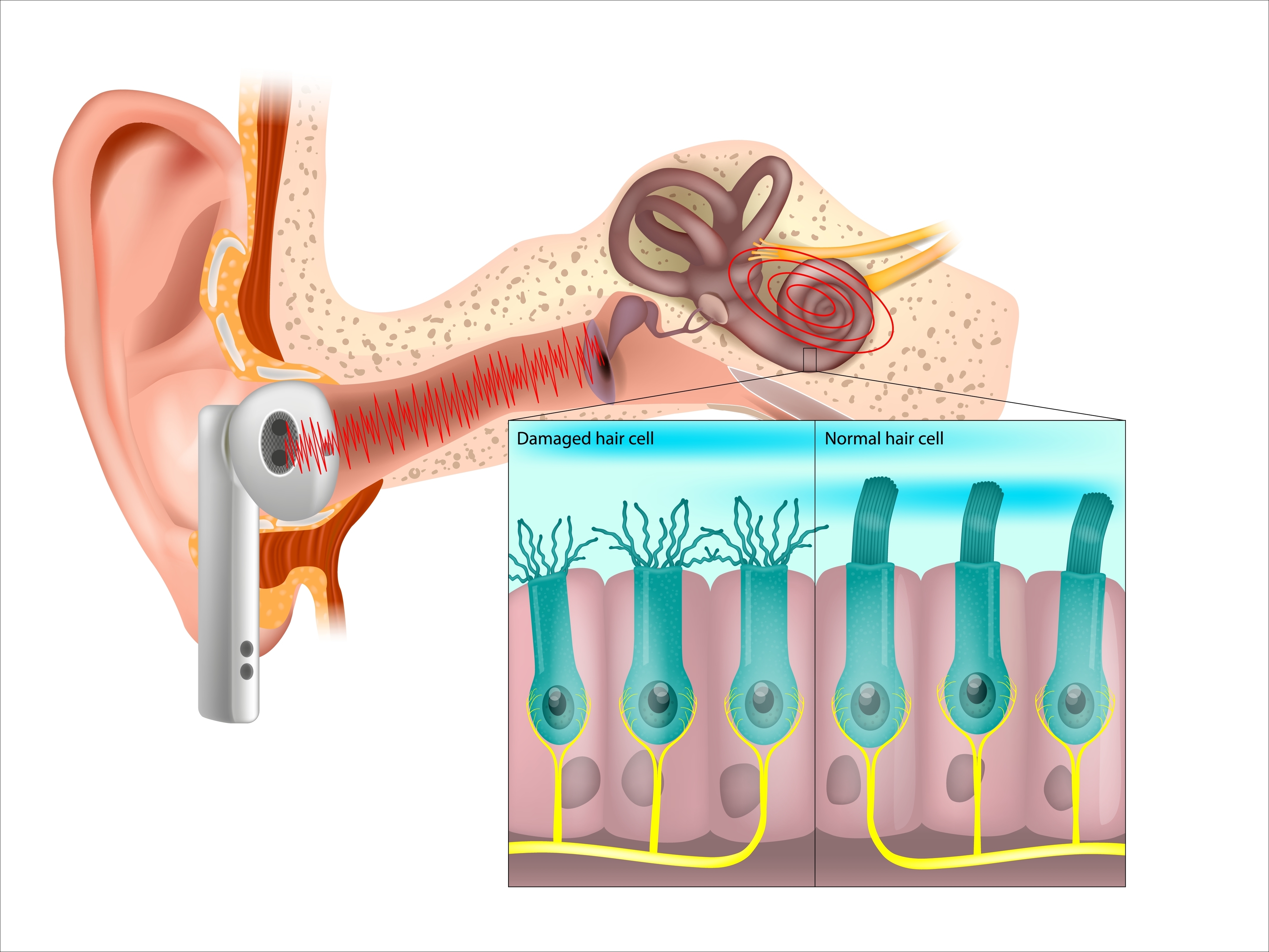 diagram of inner ear showing noise from earbuds, then zoomed-in illustration of ear hair cells in both damaged and undamaged states