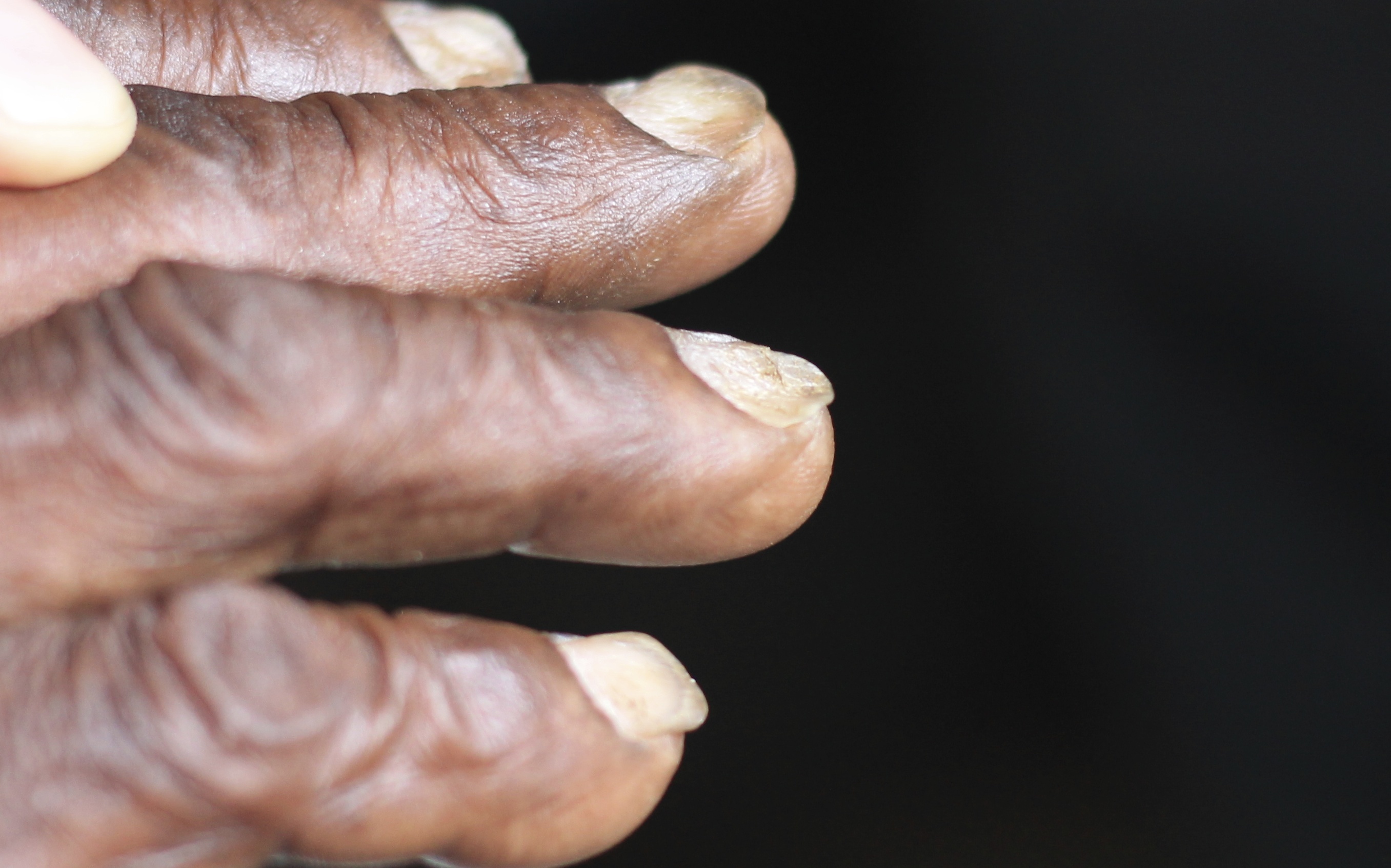 close up of hands with spoon-shaped nails