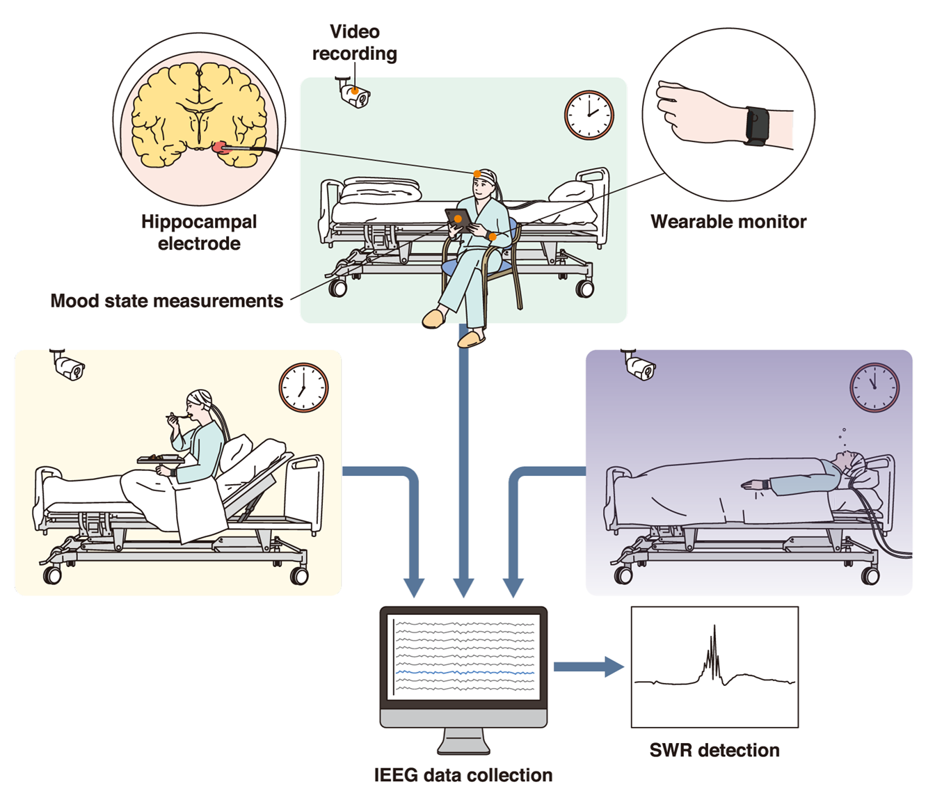 cartoon diagram showing how the study data was collected; epilepsy patients have electrodes implanted into their hippocampi and wear a monitoring device, they are also video recorded while they complete regular questionnaires about their mood; EEG data is collected and analyzed to look for sharp-wave ripple patterns