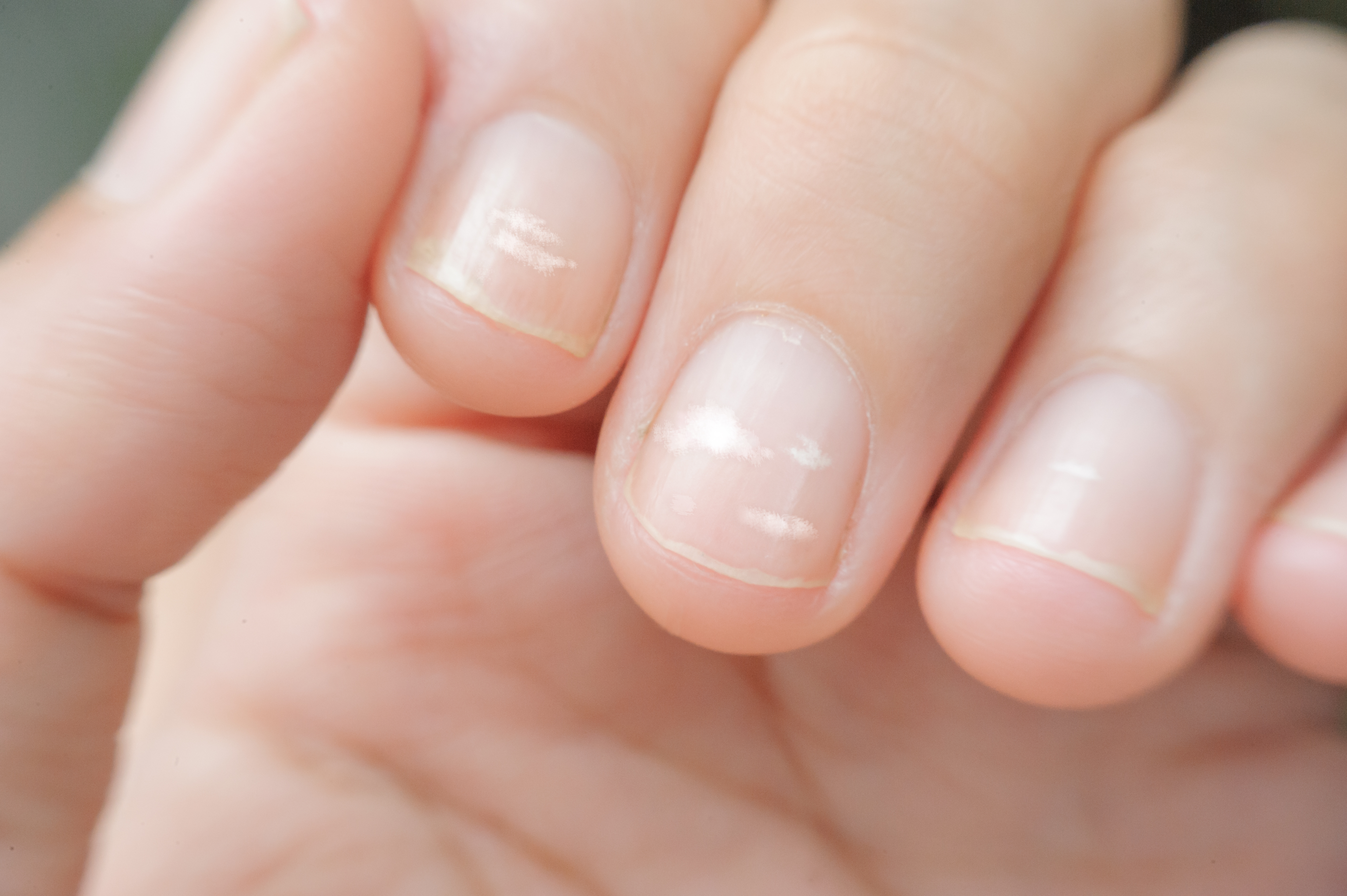 close up of white spots on finger nails, known as leukonychia