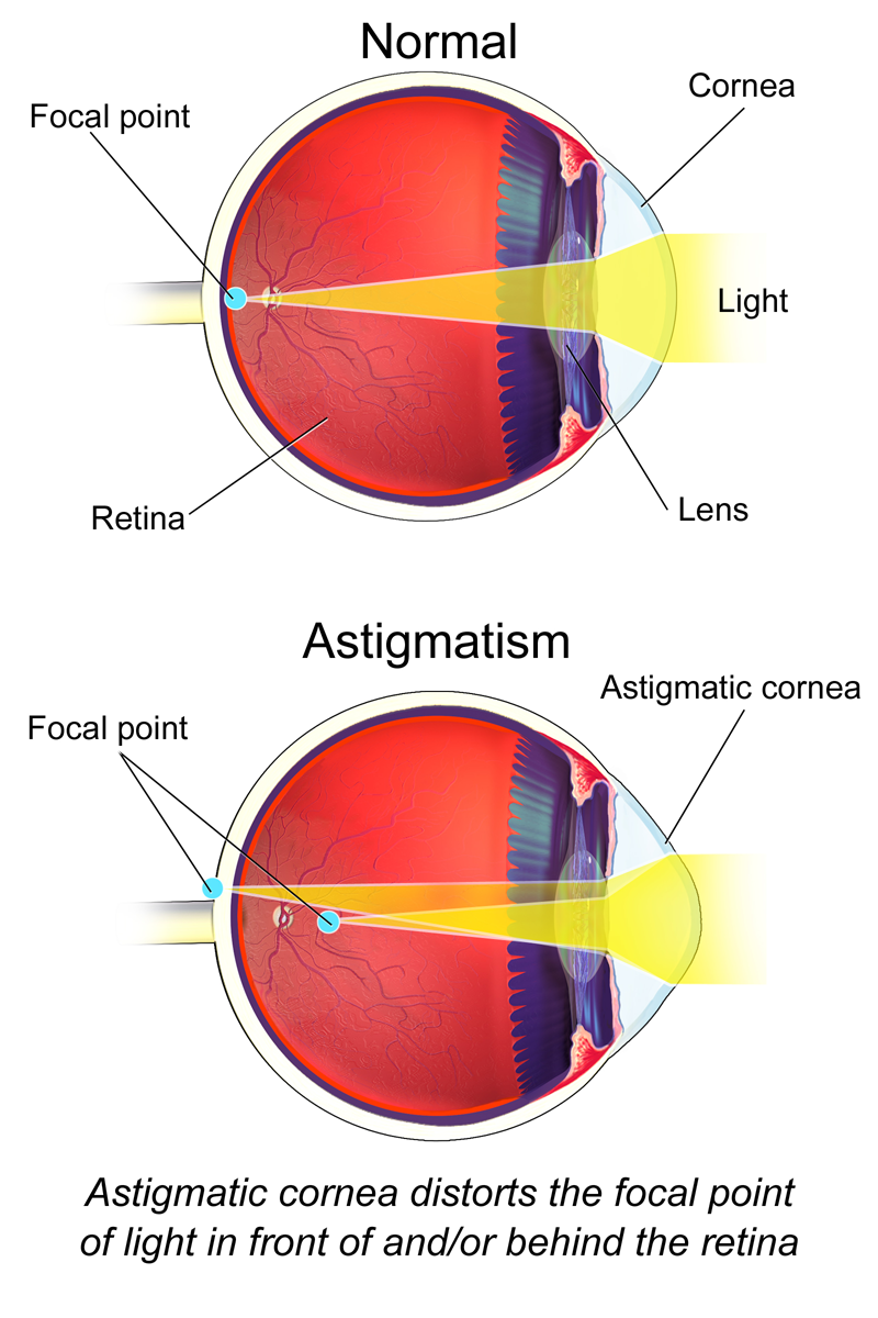 diagram of a normal eye versus one with astigmatism