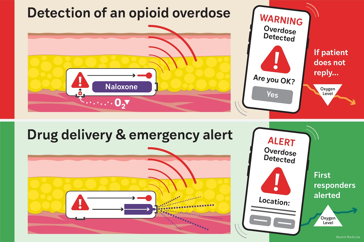 Diagram showing how the Naloximeter detects low oxygen, sends an alert to the person's phone, and then delivers naloxone and alerts the emergency services if the person does not respond to the alert