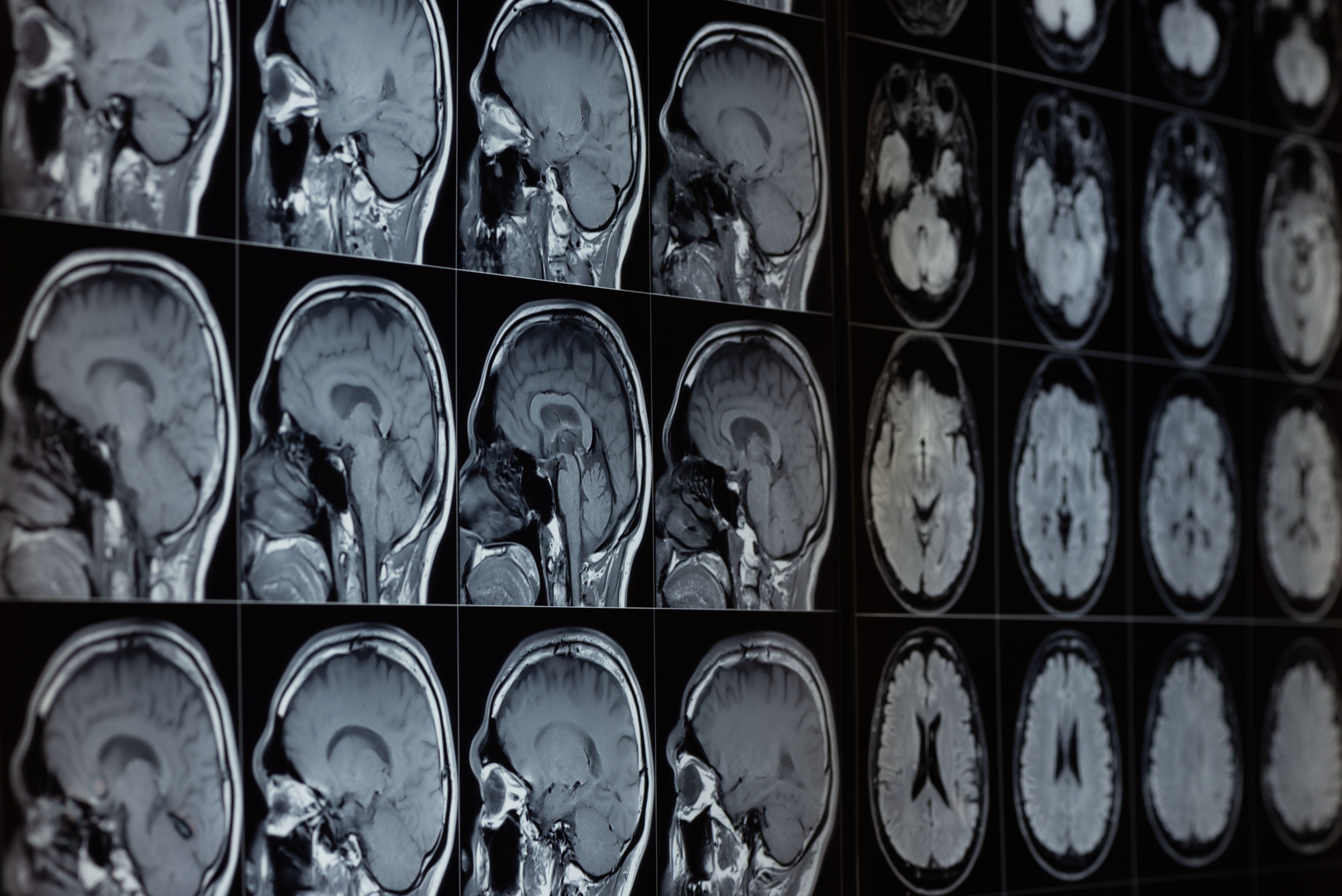 Brain MRI scans