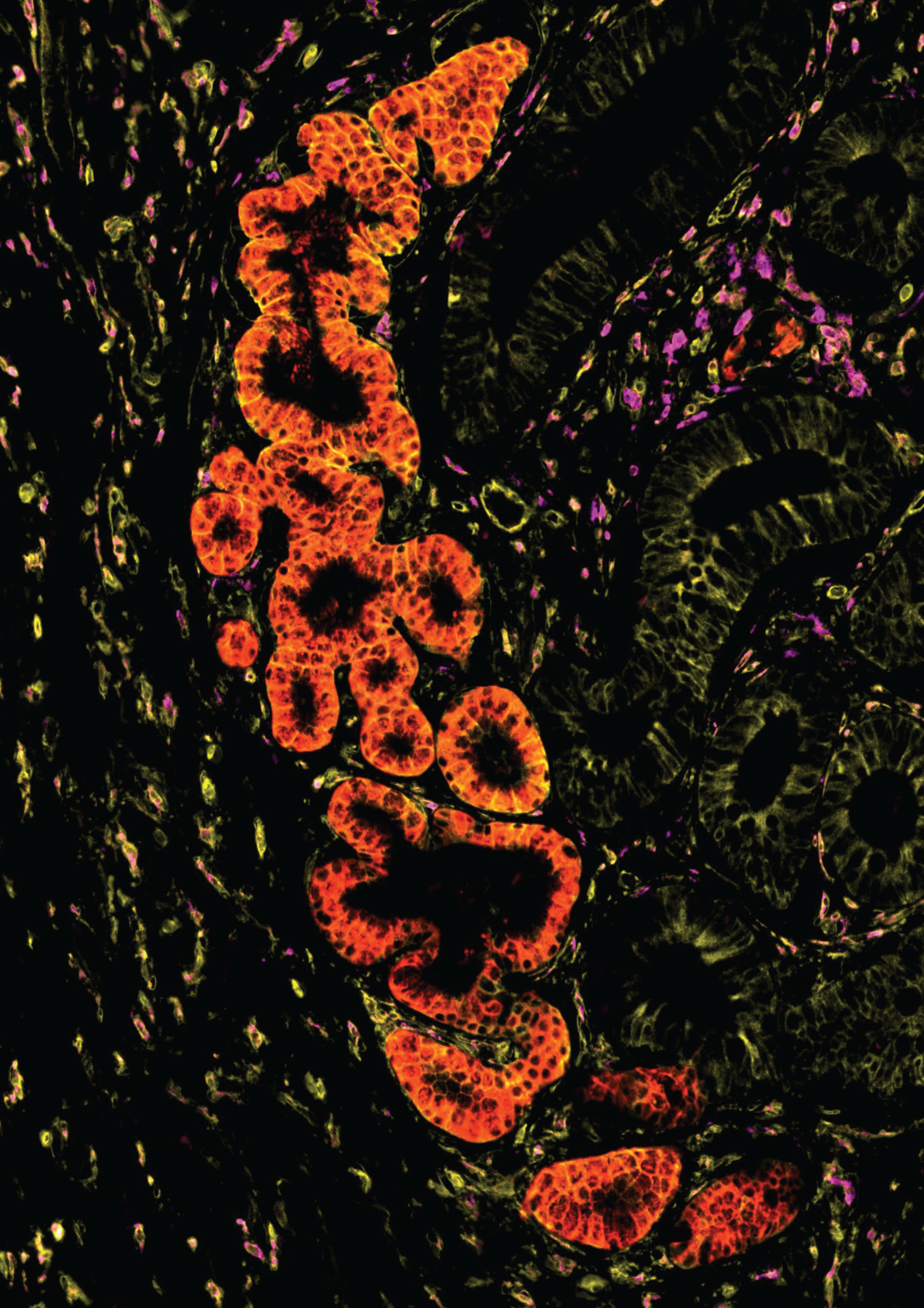 Imaging of human intestinal tissue in inflammatory bowel disease showing the presence of metaplastic epithelial glands.