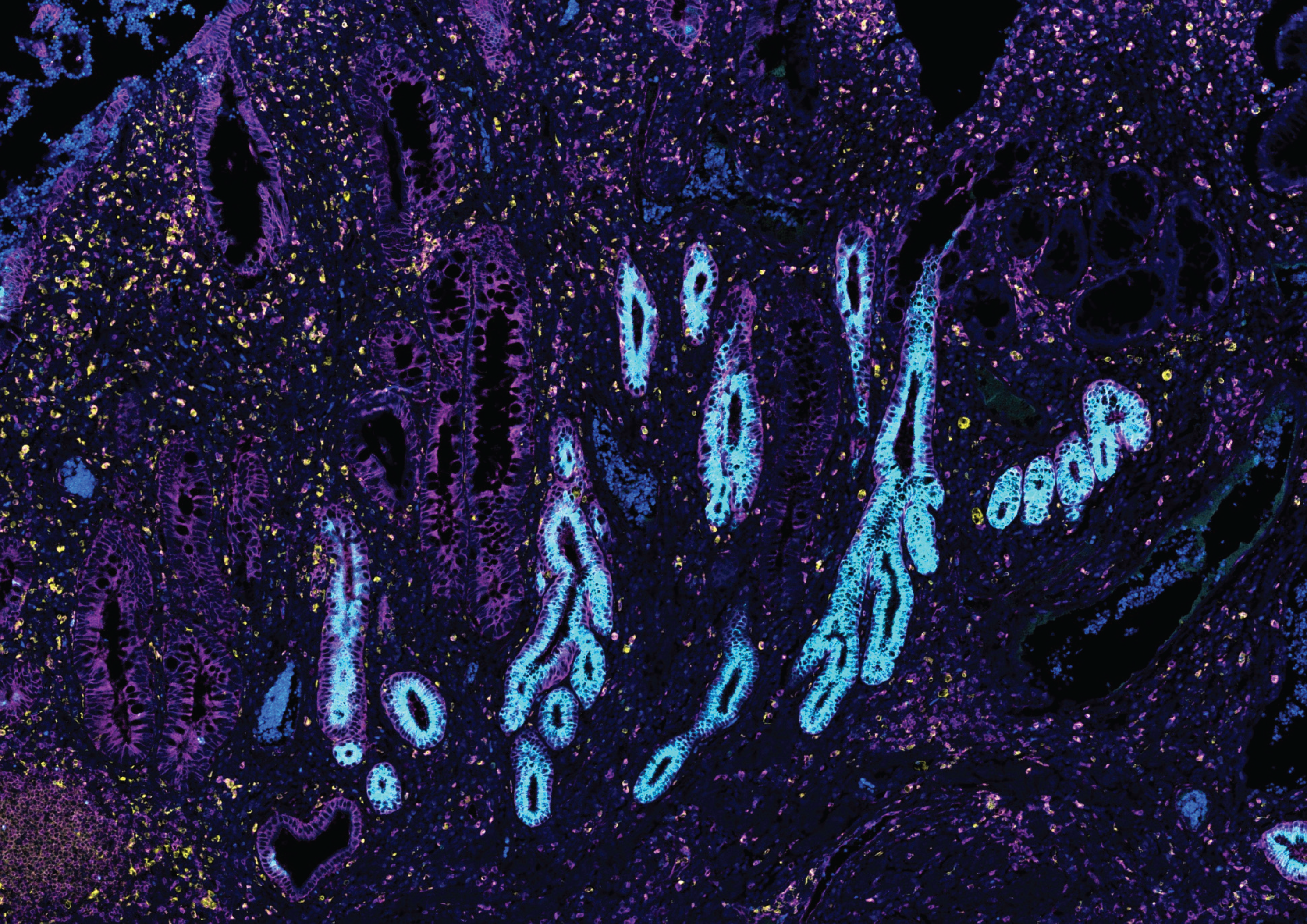 Imaging of human intestinal tissue in inflammatory bowel disease showing the presence of metaplastic epithelial glands.