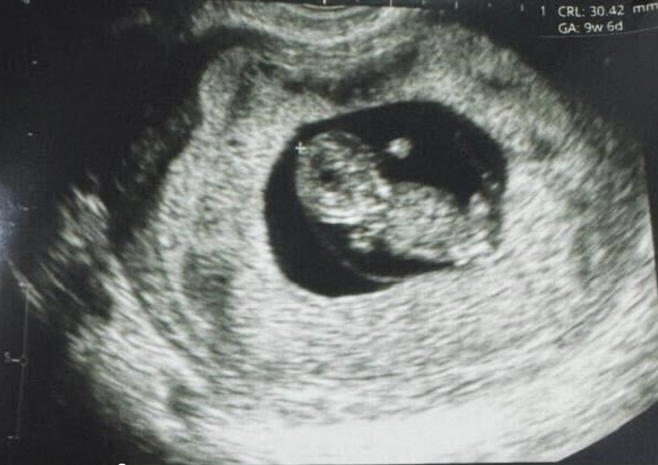 ultrasound of the baby born using the Fertilo method