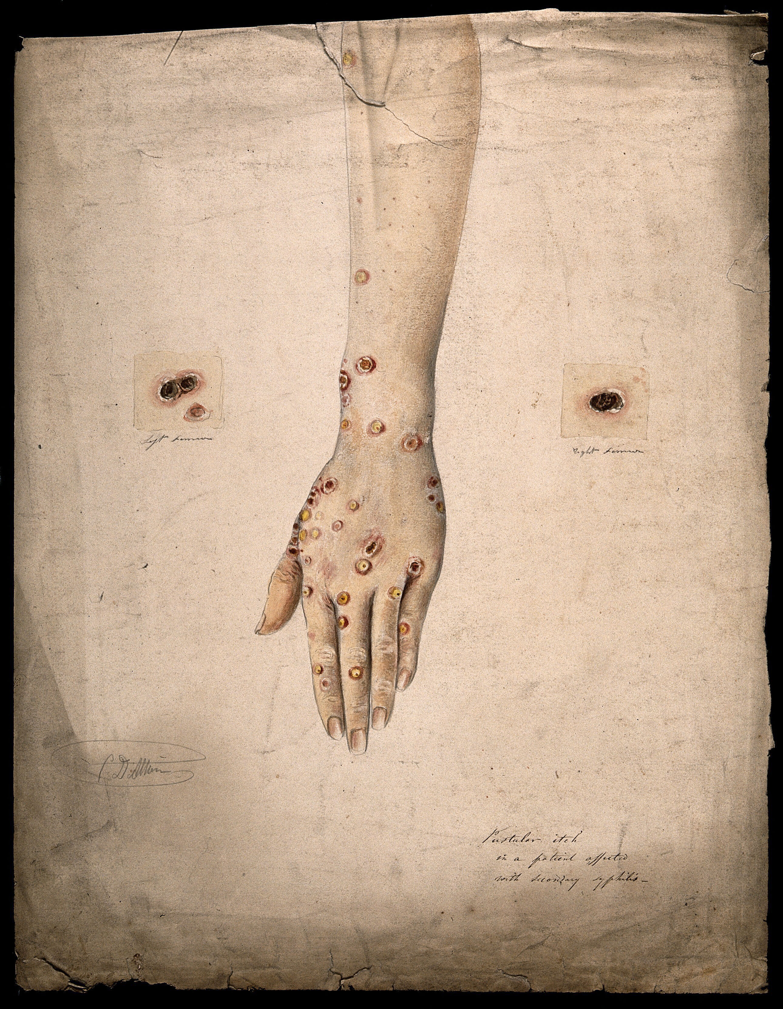 A 19th century watercolor illustration showing syphilis sores on a woman's arm. The sores are mostly located on around her hand and wrist but a few examples extend up her arm. The artist has added two close up examples of the sores either side of the arm to show what they look like in detail.  