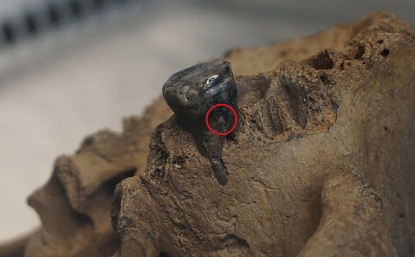 Dental calculus on the Harbin tooth, where mitochondrial DNA was captured and sequenced. Dental calculus on the Harbin tooth, where mitochondrial DNA was captured and sequenced.