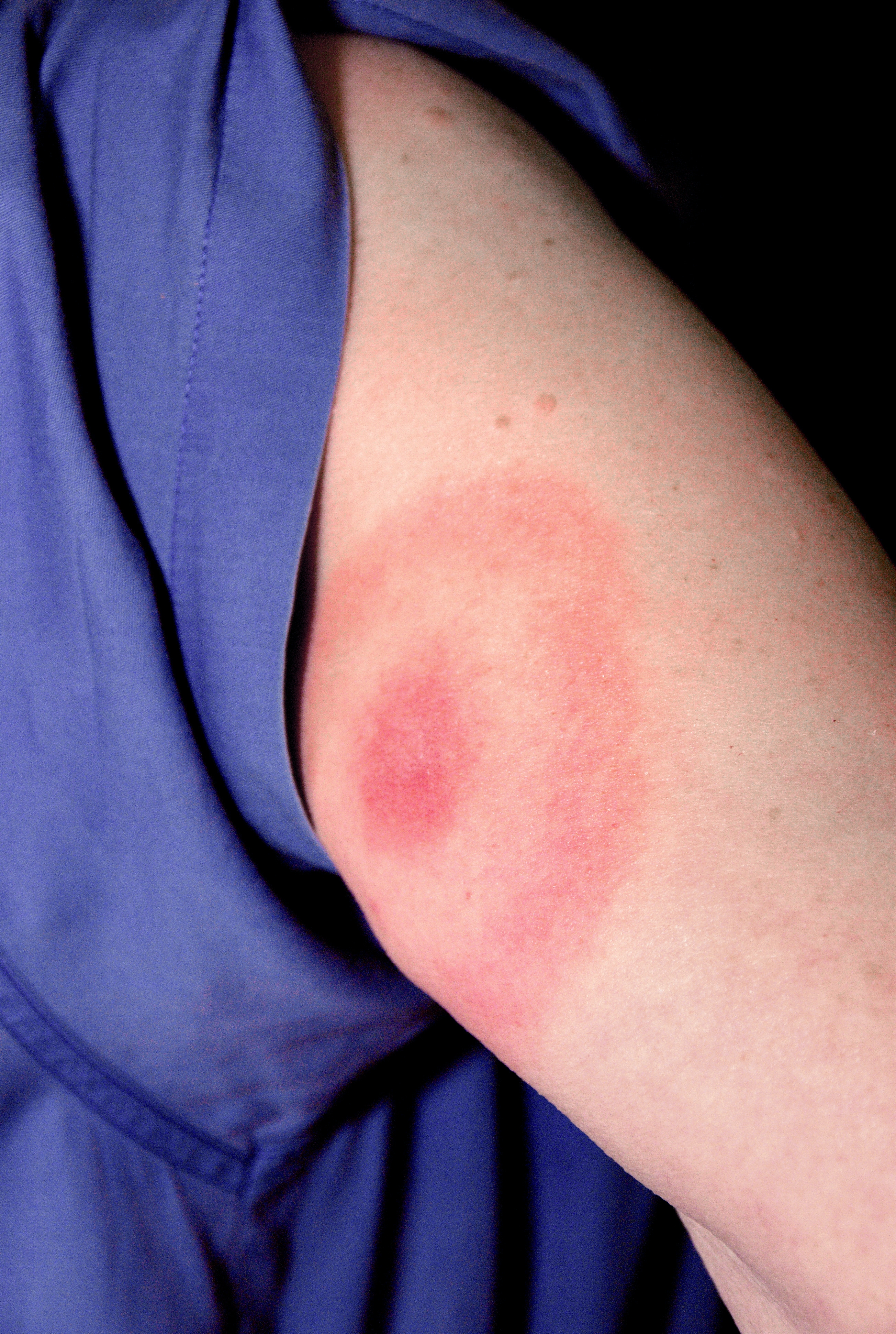 erythema migrans on the upper arm; characteristic bullseye rash from Lyme disease erythema migrans on the upper arm; characteristic bullseye rash from Lyme disease