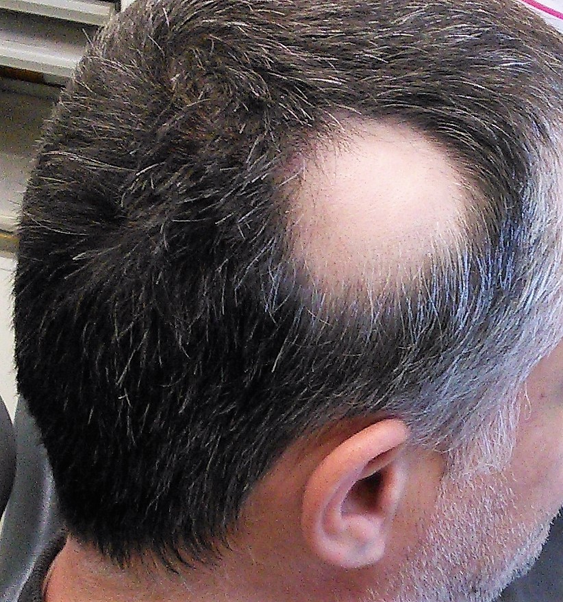 close up of man's head with a patch of hair loss near the right ear close up of man's head with a patch of hair loss near the right ear