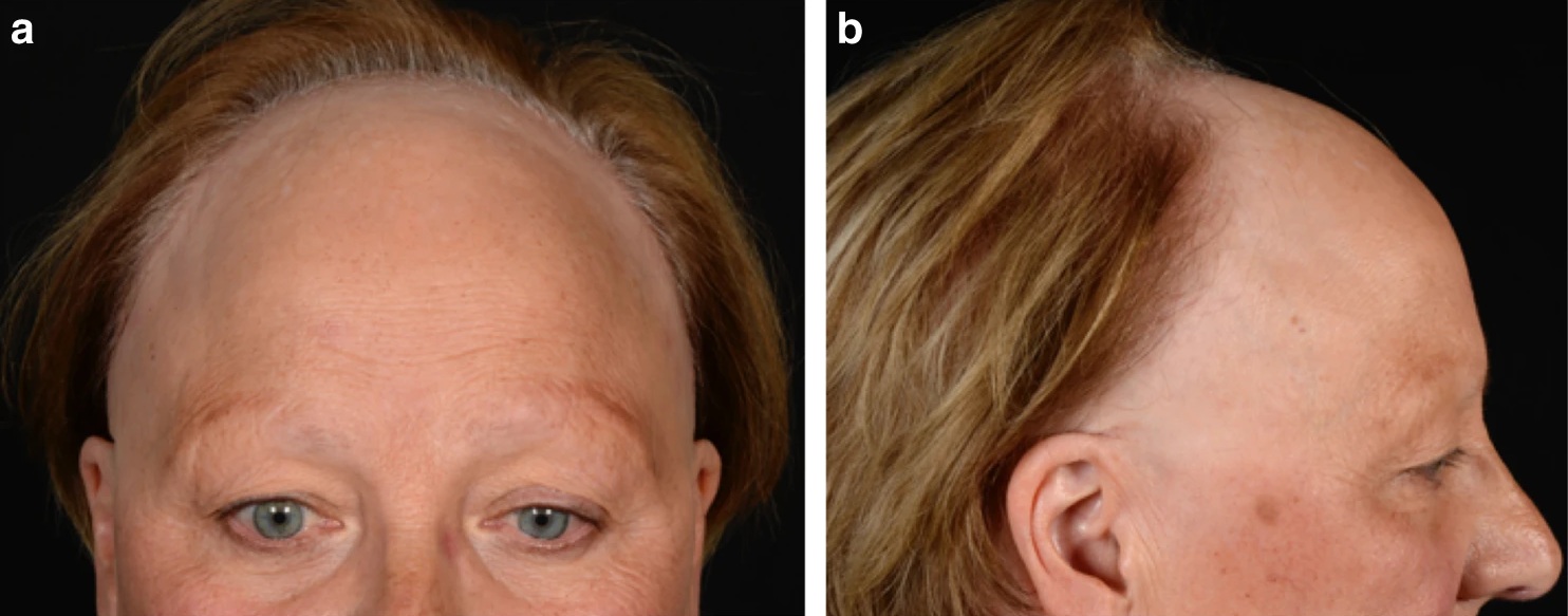 close up of woman's face showing only the eyes upwards; the hairline has receded substantially due to frontal fibrosing alopecia close up of woman's face showing only the eyes upwards; the hairline has receded substantially due to frontal fibrosing alopecia