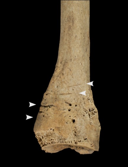 A human bone butchered by cannibals