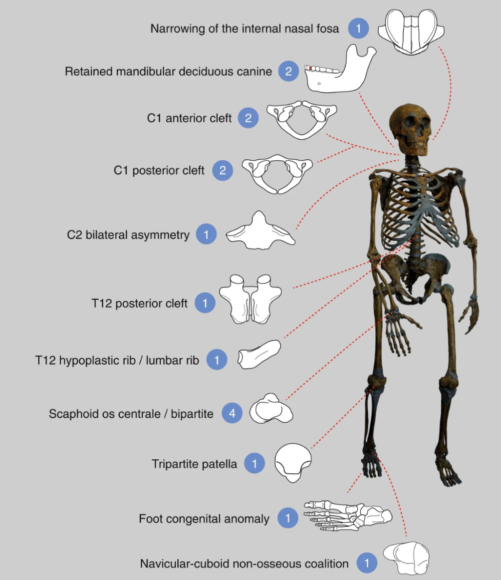 neanderthal inbreeding led to lots of congenital anomalies in neanderthals neanderthal inbreeding led to lots of congenital anomalies in neanderthals