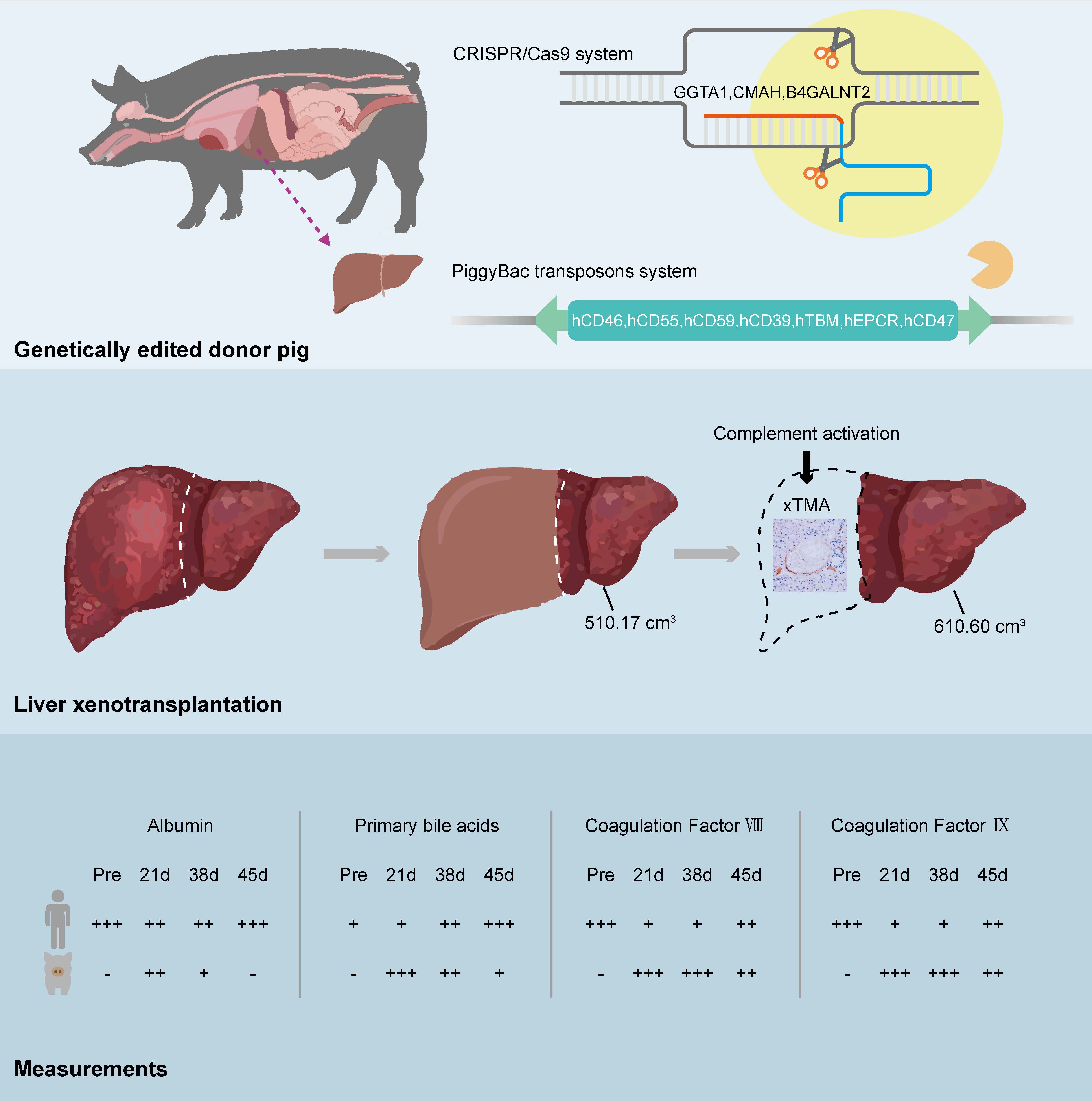 graphical abstract showing the process of genetically modifying the pig organ, how the surgical resection proceded, and several of the patient's liver and immune markers before surgery and at 21, 38, and 45 days graphical abstract showing the process of genetically modifying the pig organ, how the surgical resection proceded, and several of the patient's liver and immune markers before surgery and at 21, 38, and 45 days